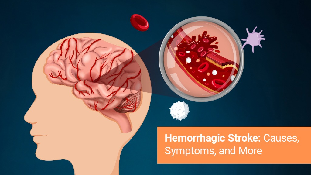 Homorrhagic stroke causes symtoms and more