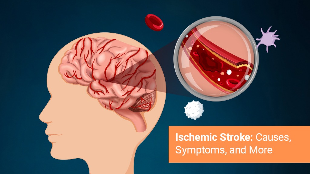 Ischemic Stroke Causes Symptoms and More